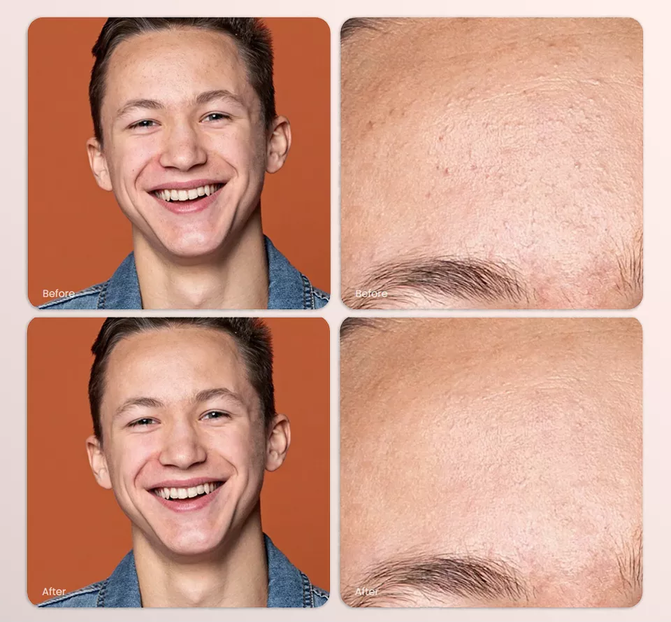 Heal - It automatically detects problem skin areas in the photo and retouches them.